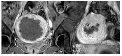 자궁근종치료_MRI조영증강2.JPG