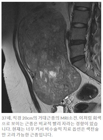 자궁근종하이푸_칼럼_김영선원장.JPG