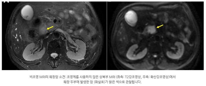 췌장암MRI.JPG